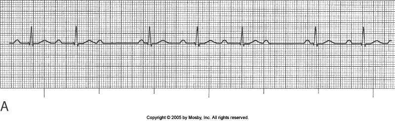 2 nd Degree Heart Block-Type I (Wenckebach) Why?