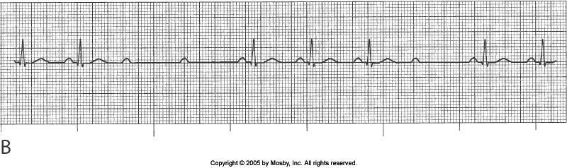 Second Degree Heart Block-Type II Why?
