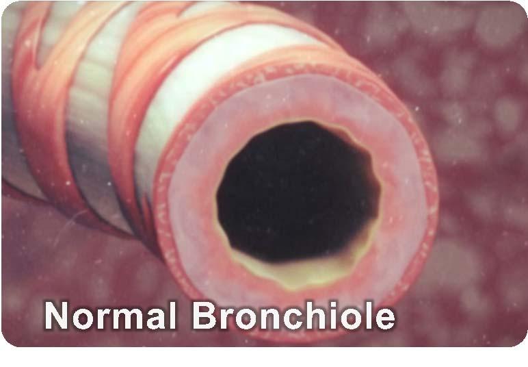 Chronic Bronchitis and Airway Inflammation In healthy lungs, the airways are elastic and flexible With chronic bronchitis, airways can become swollen or thicker