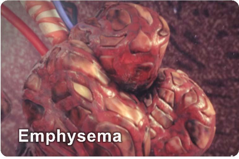 Emphysema involves damage to the walls of the alveoli In emphysema, alveoli lose