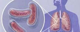 What is Tuberculosis Tuberculosis is a bacterial infection