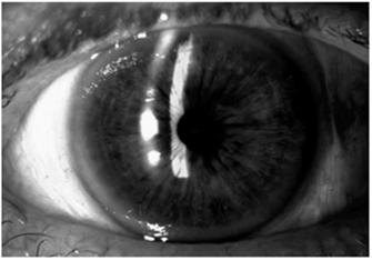 LPI Location: Temporal vs Superior LPI Location New-onset linear dysphotopsia was reported in 18 (10.7%) eyes with superior LPI versus 4 (2.4%) eyes with temporal LPI (P =.002). Eleven eyes (6.