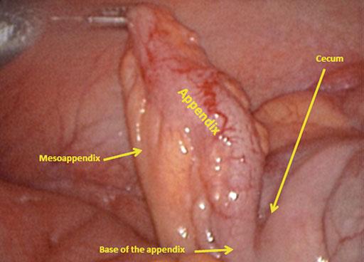 2 Acute Appendicitis 9 appendectomy is necessary to avoid diagnostic confusion in the future.