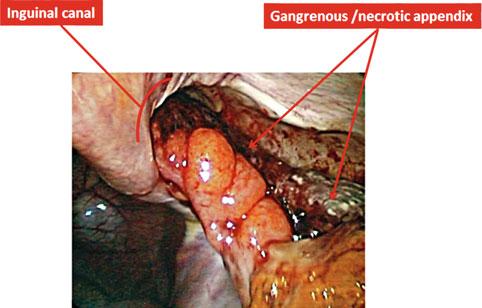 10 L.C. Sakata and L. Perea Fig. 2.3 Gangrenous appendicitis in an inguinal hernia (Amyand s hernia).