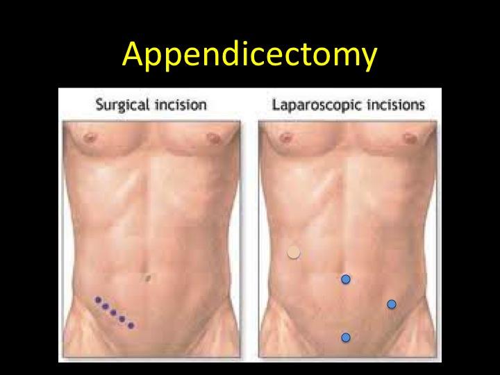 Most laparoscopic appendectomies start the same way. Using a cannula (a narrow tube-like instrument), the surgeon enters the abdomen.
