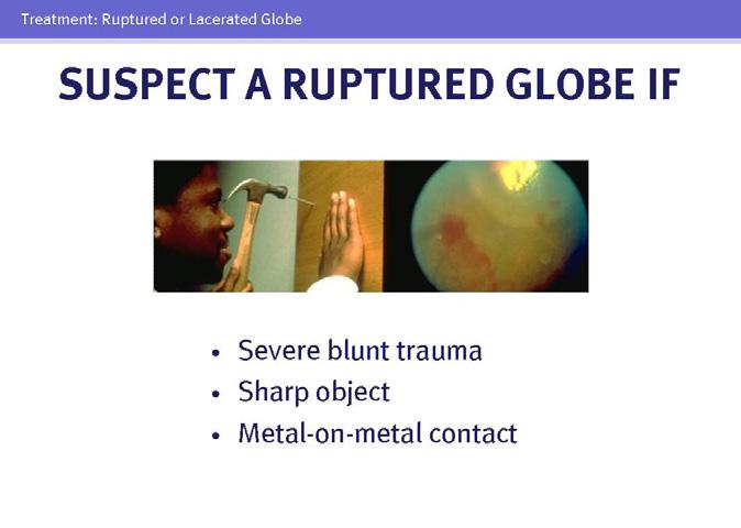 Ruptured or Lacerated Globe 13 14 15 Laceration or rupture of the globe is one of the most serious ocular injuries.