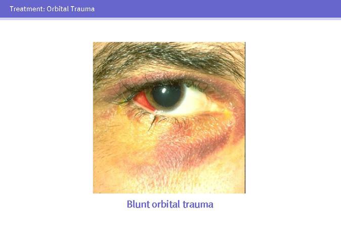 Orbital Trauma 27 28 29 Blunt trauma to the orbit can result in periorbital swelling, ecchymosis, and orbital bone fractures.