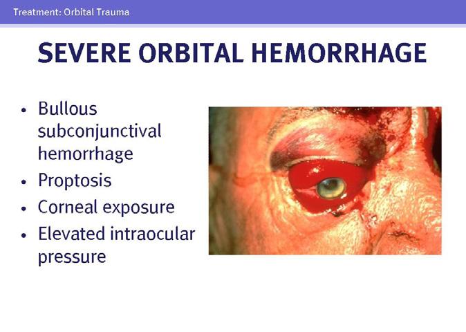 Orbital trauma may also cause mild, nonbullous subconjunctival hemorrhaging, which is typically a benign, self-limited condition.