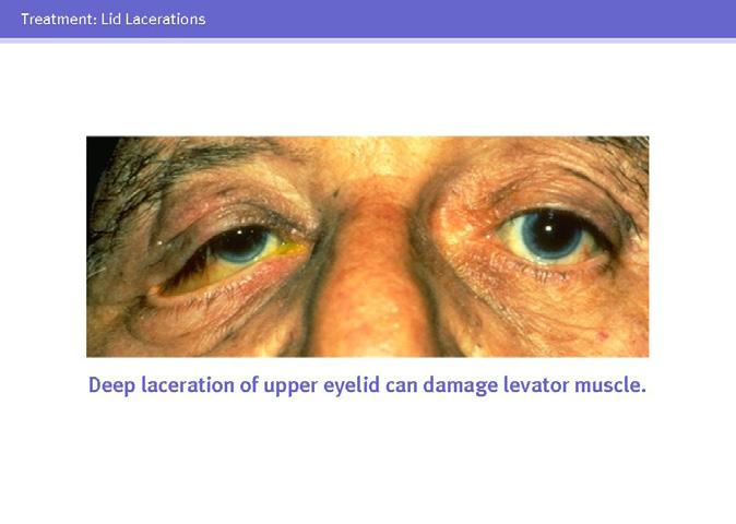 33 Full-thickness lacerations involving the lid margin must be repaired in layers.