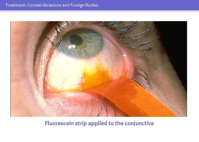 40 Topical fluorescein is helpful in evaluating such corneal injuries. After instillation of a topical anesthetic, a moistened fluorescein strip is applied to the inferior conjunctival surface.
