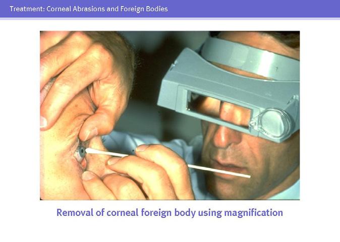 44 Foreign bodies lodged on the corneal surface are more easily and safely removed with magnification, such as a loupe or the slit lamp, after instillation of a topical anesthetic.