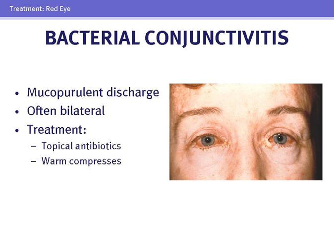It may be associated with a systemic viral illness, and patients present with conjunctival inflammation and a watery or mucoid discharge often with preauricular lymphadenopathy.