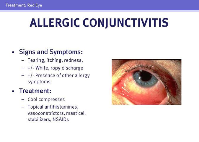53 A special category of bacterial conjunctivitis is gonococcal conjunctivitis. Gonococcal conjunctivitis should always be considered when a markedly purulent conjunctivitis is present.