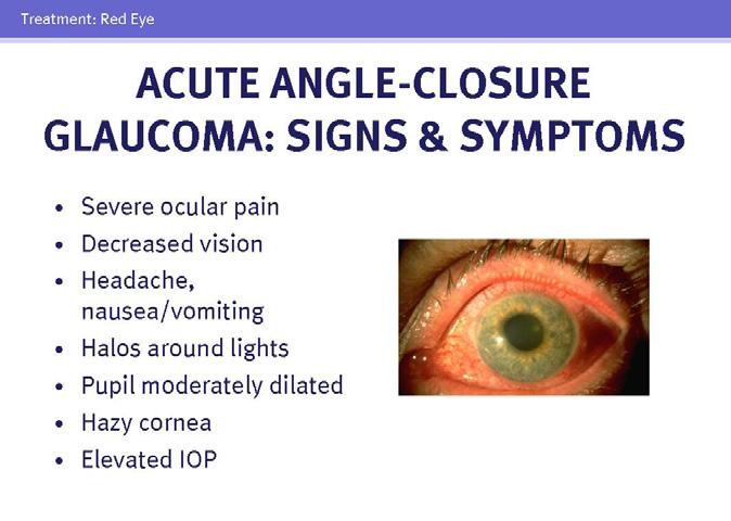 58 59 Patients with acute angle-closure glaucoma present with severe eye pain and decreased vision. Symptoms may also include headache, nausea, vomiting, and colored halos around lights.