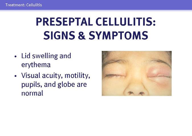 Cellulitis 60 Cellulitis is an urgent and potentially vision-threatening problem. The distinction between preseptal and orbital cellulitis is important.