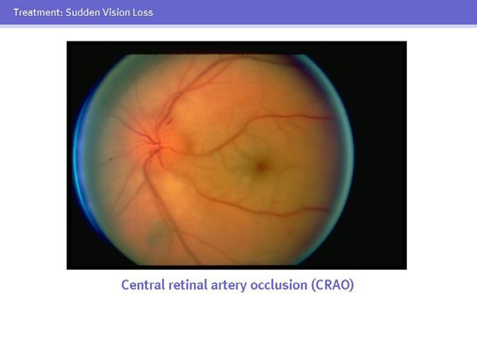 These include central retinal artery occlusion, central retinal vein occlusion, retinal detachment, optic neuropathy caused by temporal arteritis, nonarteritic optic neuropathy, and vitreous