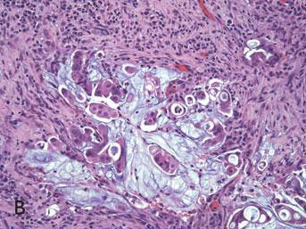 16 Carcinomas derived from serrated neoplasms may display conventional, or