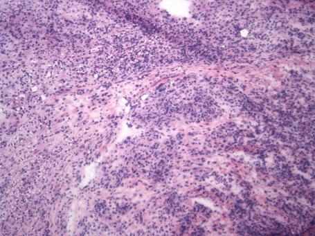 Appendiceal Mucinous Neoplasms 87 may be associated with mesoappendiceal abscesses.