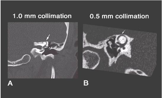 abnormality in development of bone overlying the canal Acquired