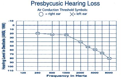 tube dysfunction. Tympanometry can help in the detection of middle ear fluid when the physical exam is unclear. Conductive Hearing Loss: Figure 6.2. Audiogram of a patient with presbycusis.