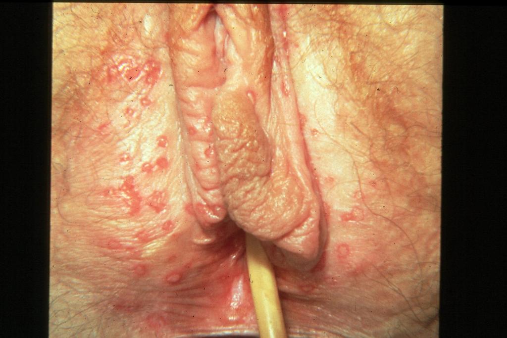 Primary herpes, in atopic skin with a poor