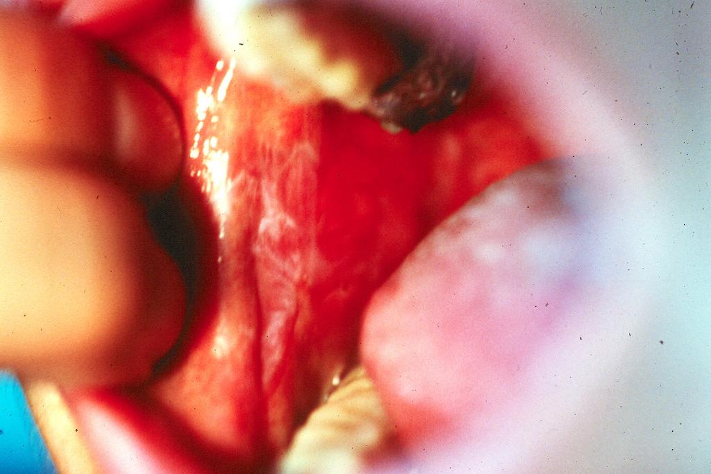 Chronic oral ulcer