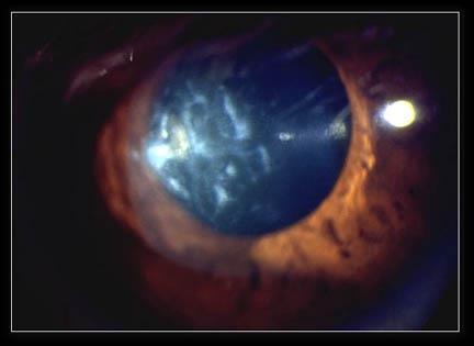 Keratoconus-Scarring Penetrating Keratoplasty Pellucid Marginal Degeneration Bilateral corneal disorder hallmarked by a