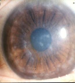 Macular Corneal Dystrophy Surgical treatment usually required by 2nd or 3rd decade of life.