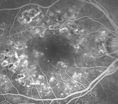 Diabetic Macular Edema laser treatment Laser treatment is the gold standard Laser destroys the leaking microaneurysms Laser