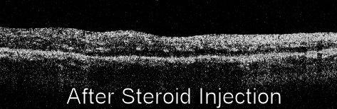 1 ml kenalog Often effective in reduction of retinal edema Effect may be transitory Often used in combination with laser