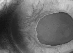 Neovascularization of Iris from Diabetic