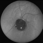Retinal Detachment Repair Scleral Buckle Vitrectomy Pneumatic Retinopexy Selective cases Superior tears (between 10 and 2 o clock) No other retinal