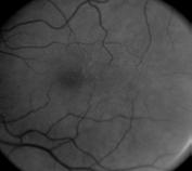 AMD Damages the Macula Early AMD Retina Choroid Sclera Fovea Retina Choroid Sclera Macula RPE Bruch s Membrane