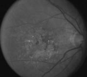 AMD: Non-Neovascular Fundus photograph depicting central geographic atrophy Vision impairment is more severe Follow fellow