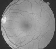 1 Incidence based on diagnosis codes associated with AMD and CNV 1 3-year incidence of AMD 9.4 to 11.
