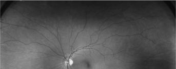 Macula Small area in center of retina that allows you to see