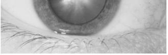 kidney failure Diabetic Retinopathy Cornea Causes of Vision Loss Damage to nerves impairs the cornea s