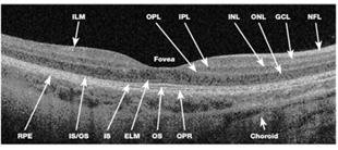 retinopathy.