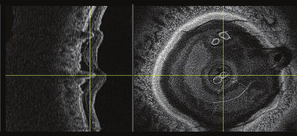 Swept-Source Optical Coherence Tomography A Color Atlas Kelvin Y.C. Teo Wong Chee Wai Andrew S.H. Tsai Daniel S.W. Ting Singapore National Eye Centre, Singapore Edited by Lee Shu Yen and Gemmy C.