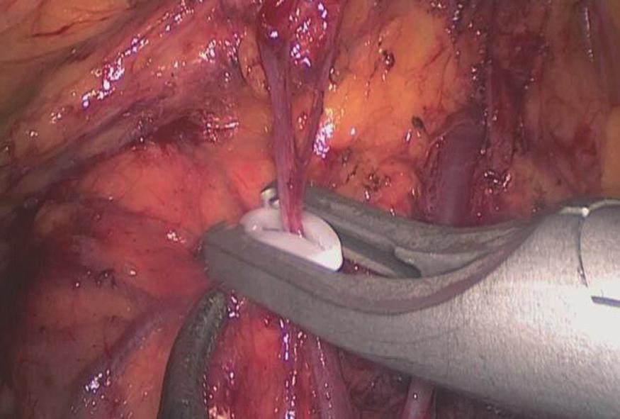 amputated the right colic vein; (D) free the space in front of the head of the pancreas; (E) free the hepatic