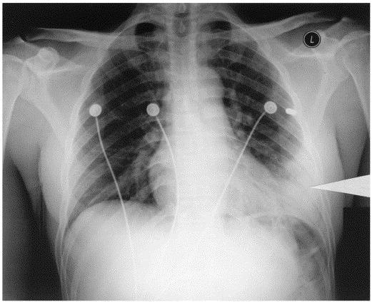 Anatomic Considerations Incomplete ossification of ribs allows anterior ribs to be compressed to meet posterior Pulmonary contusions are common, rib fractures uncommon Presence of rib fractures in
