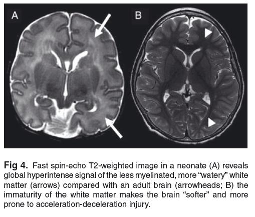 At birth, the brain contains very little myelin Progressive decrease in water content from birth until the brain is fully myelinated Neonatal brain water content is ~89%, adult content is 77% Brain