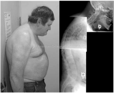 Case 1: pain in the Neck Real case with modifications 89 year-old man with history of ankylosing spondylitis who suffered a ground-level fall after his feet got tangled on the edge of the living room