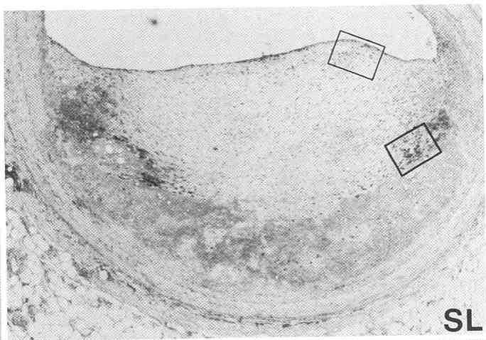 Metalloproteinase and Gelatinolytic Activity of Human Coronary Artery Atherosclerotic Plaques From Galis et al, J Clin Invest, 1994
