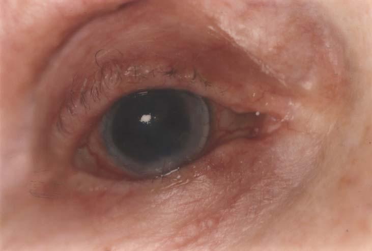 Fig. 5: Postoperative appearance of the same eye after the first reconstructive keratoplasty with an unaided vision of 6/60 six months after the operation.