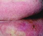 moist, the epidermis becomes weaker and more fragile this can lead to skin breakdown in the presence of pressure, shear and/or friction.