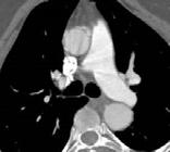 Aortic size predicts dissection
