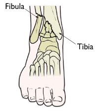 Copyright 2010 American Academy of Orthopaedic Surgeons Pilon Fractures Pilon fractures affect the bottom of the shinbone (tibia) at the ankle joint.
