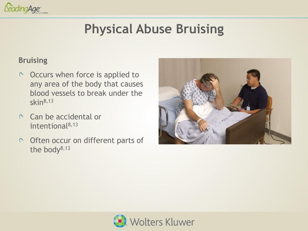 Bruising may be the first sign of abuse. It occurs when force is applied to any part of the body that causes blood vessels to break underneath the skin.