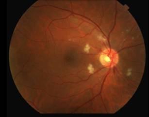 o Iris: Normal OU o Lens: 1+ nuclear sclerosis OU o Vitreous: Clear OU, no Shafer s sign OU Dilated Fundus (Figure 1) Disc: pink, sharp borders, multiple cotton wool spots (CWS) surrounding the
